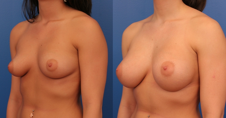Marietta Breast Implants