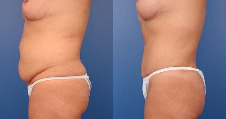 Tummy Tuck Left Lateral
