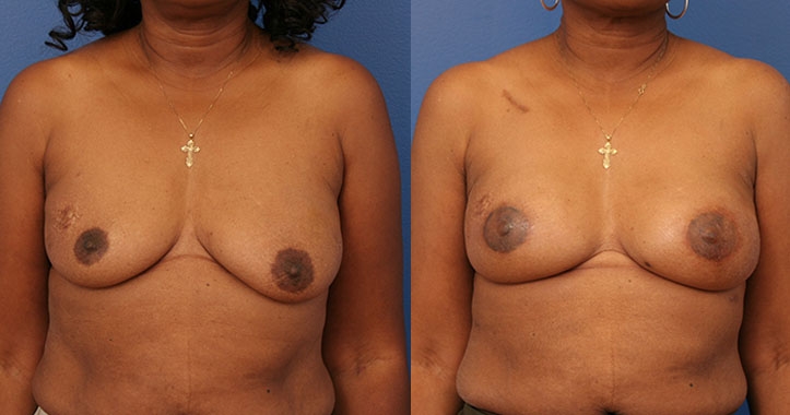 Atlanta Latissimus Dorsi Breast Reconstruction 