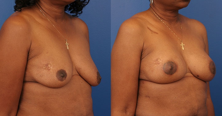 Atlanta Latissimus Dorsi Breast Reconstruction 