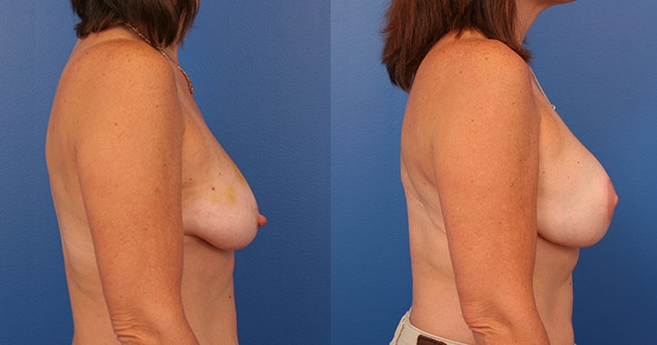 Atlanta Latissimus Dorsi Breast Reconstruction