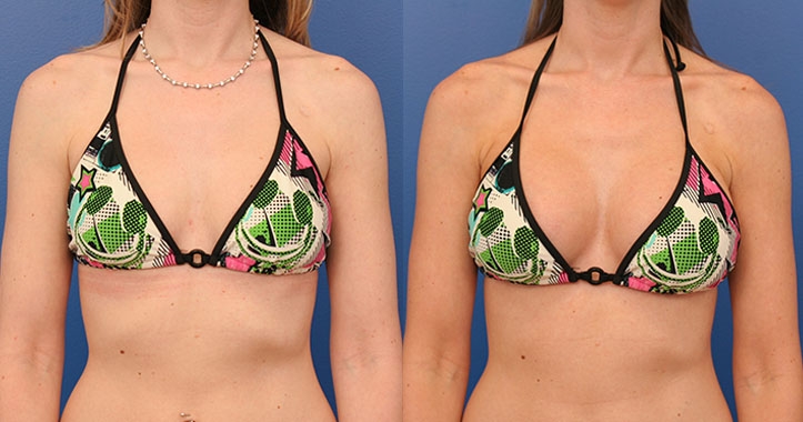 Breast Implants AP Bikini