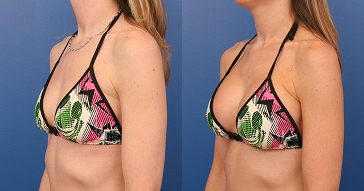 Breast Implants Lt Quarter Bikini