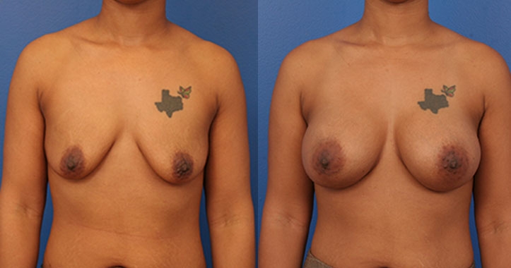 Kennesaw Breast Augmentation