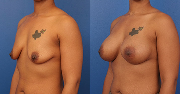 Atlanta Breast Implants