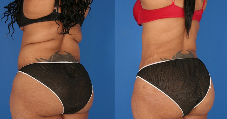 Marietta Liposuction Tummy tuck