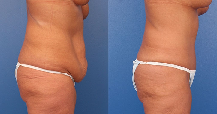 Tummy Tuck Right Lateral